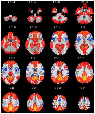 Extracting default mode network based on graph neural network for resting state fMRI study